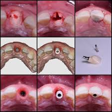 Comprehensive Guide on the Healing Process for Tooth Implants: What to Expect at Every Stage