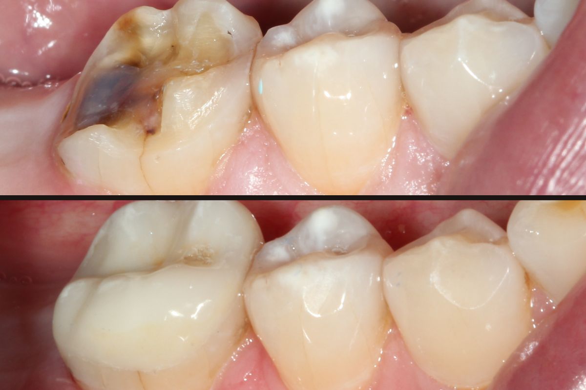 Cosmetic Solutions for Rotten Teeth: Restoring Your Smile