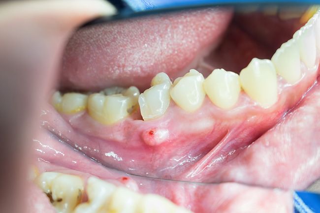 Dental Abscess Lump On Jaw Bone