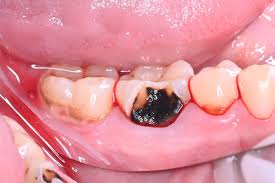 Dental decay can cause back molar pain