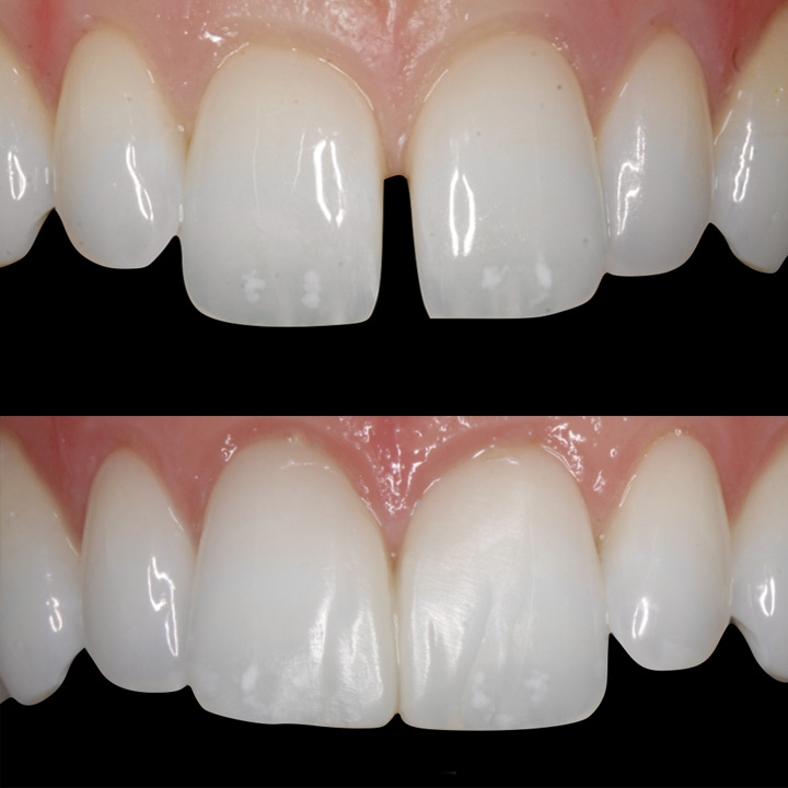 Diastema-Gap-Closure | Dental Bonding to Reduce Gap Between Teeth