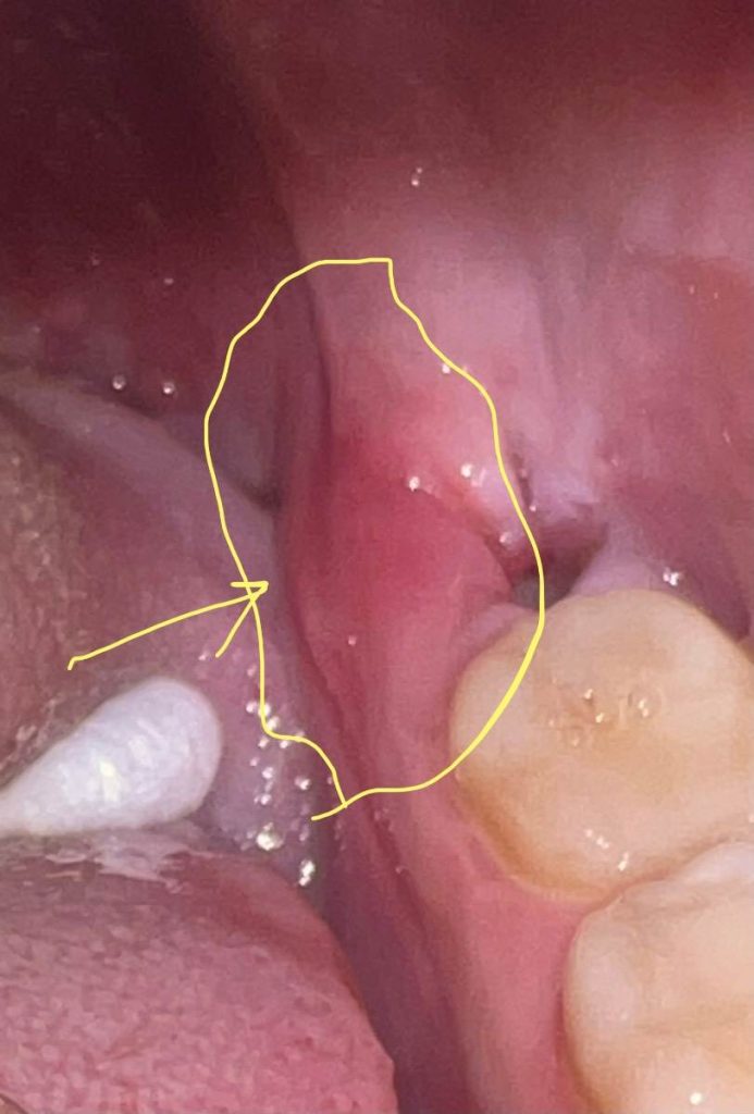 Dry Socket- Infected Gum After Wisdom Tooth Removal Symptoms, Causes, and Treatment