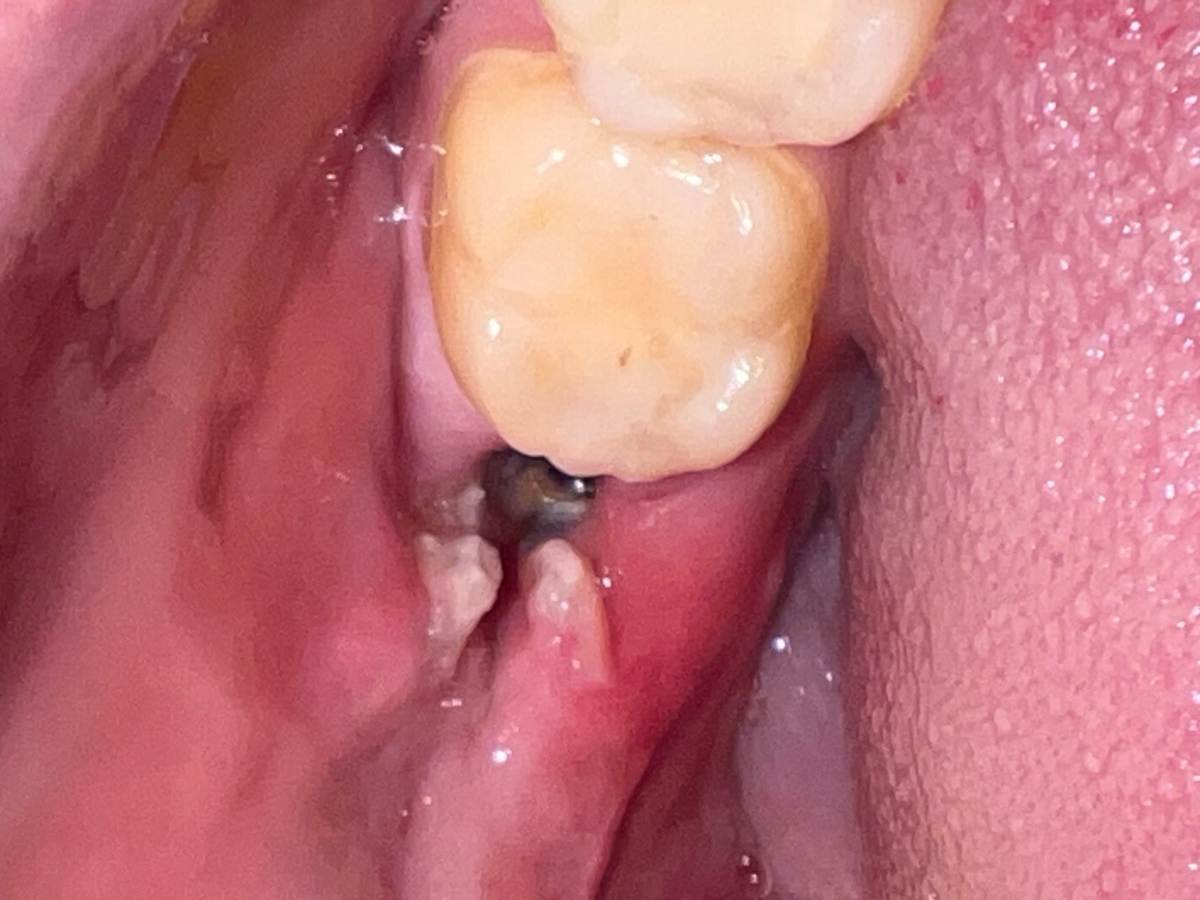 Dry Socket- Patient having bad taste in mouth 7 days after wisdom teeth removal due to infected gum after wisdom tooth removal