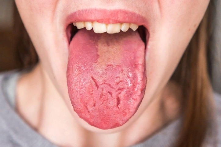 Dry mouth caused by drugs, systemic diseases, gentic syndromes etc, can be the reason for weird taste in mouth