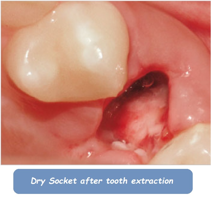 Normal Socket vs Dry Socket After Tooth Extraction: Key Differences, Symptoms, and Prevention