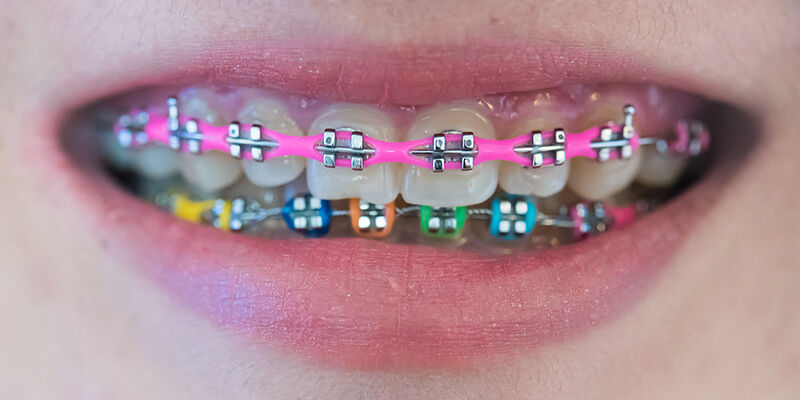 Power Chains in Braces: What They Are, How They Work, and Why They Matter for Your Orthodontic Treatment