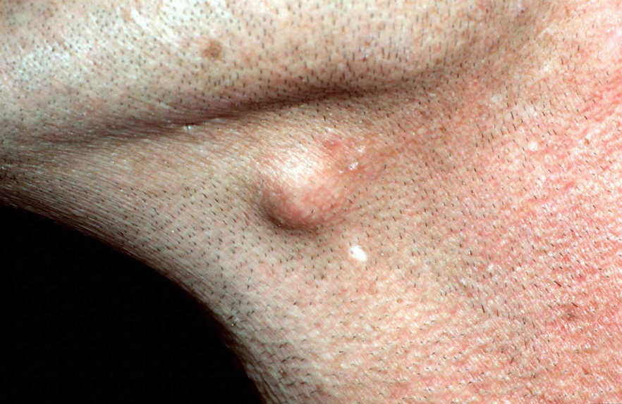 Epidermal cyst-lump under jaw line right side