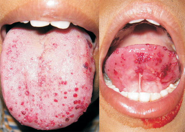 red pimples in tongue, Eruptive Lingual Papillitis (Family Form)