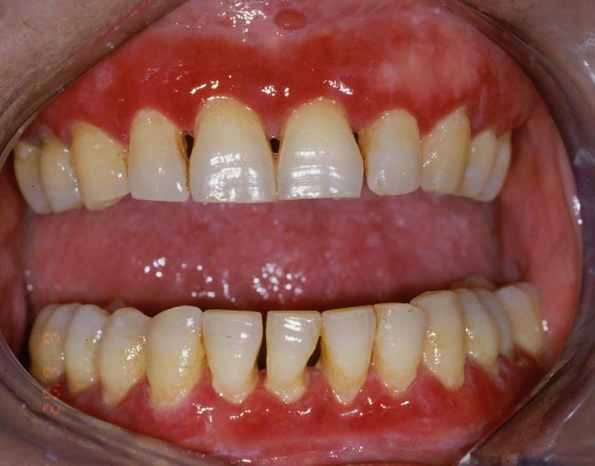 Erythema and desquamation of the gingiva by gingivitis and periodontitis having symptoms of peeling gums.