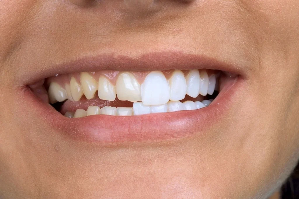 Everything You Need to Know About Veneers: The Ultimate Guide to Dental Veneers for a Perfect Smile