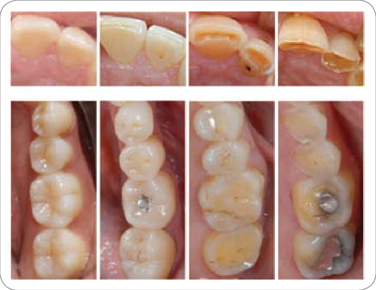 The Stages of Enamel Erosion: Understanding the Progression of Tooth Damage