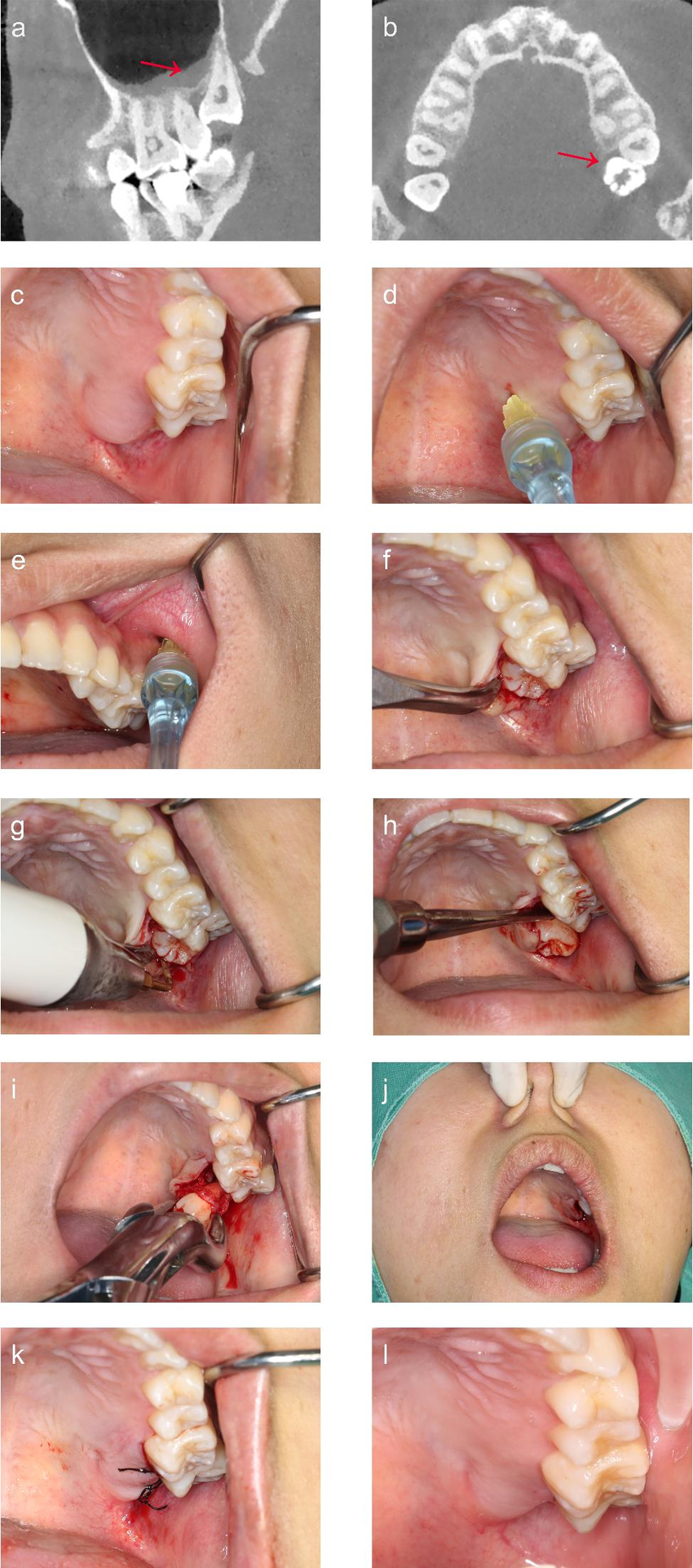 Steps to take wisdom tooth out