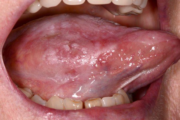 mouth cancer picture showing tongue cancer