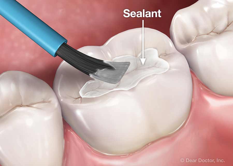 Fluoride and Sealants: Essential Tools in Preventing Tooth Decay