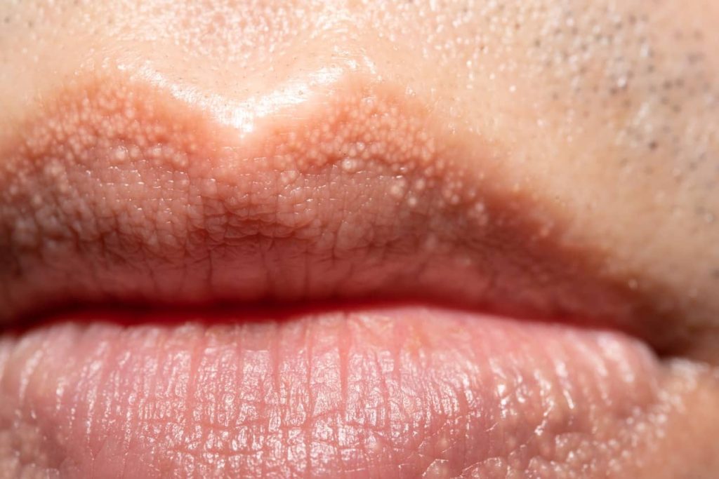 Tiny Bumps on Lips: Causes, Symptoms, and When to Seek Help (Not Cold Sores, Not Herpes)