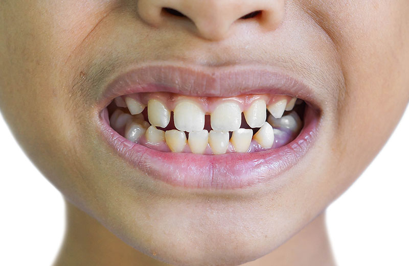 10 Expert Ways on How to Reduce Gap Between Teeth Naturally at Home| Tips and Solutions