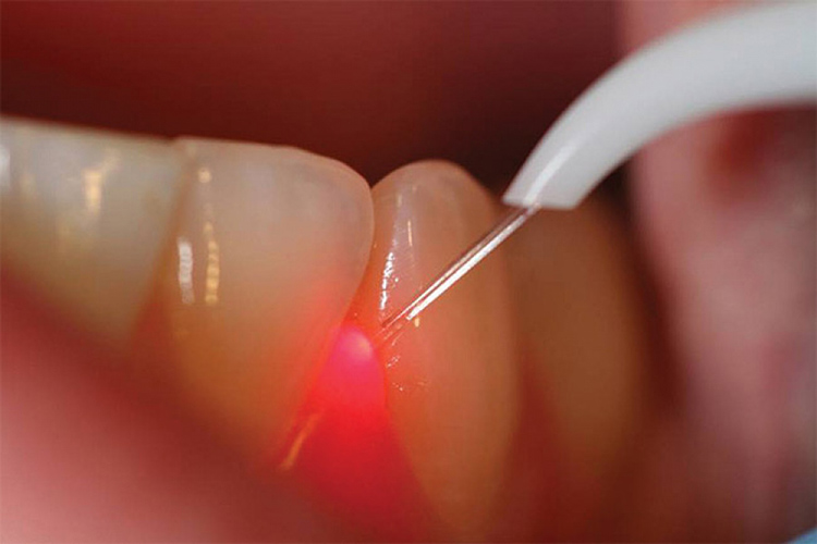 Gum disease medical procedure of Laser gum surgery