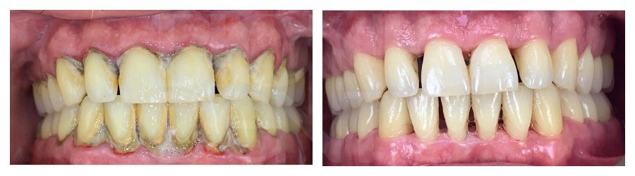 Gum disease treatment-gum disease medical procedure of scaling to remove calculus, plaque and tartar buildup from teeth