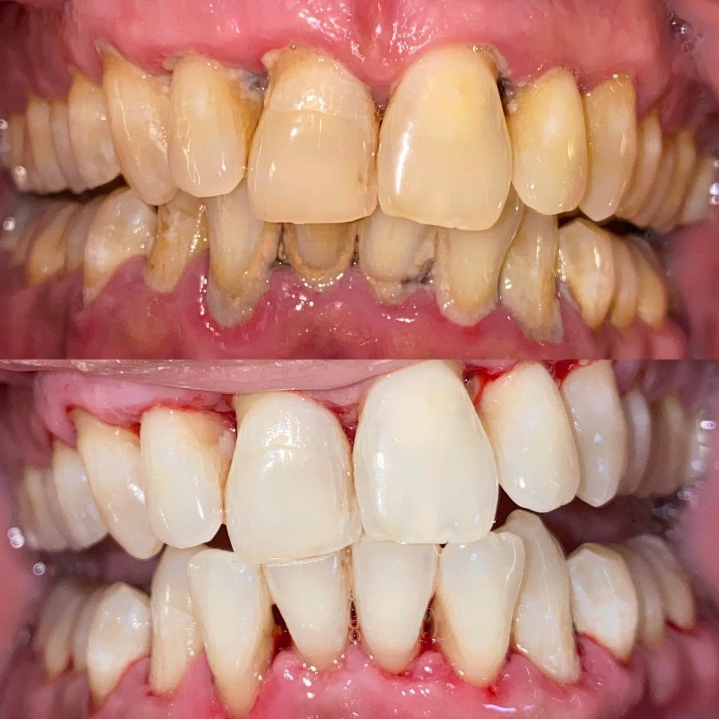 Gum disease treatment-periodontal disease treatment of scaling and polishing to eliminate Periodontitis and Gingivitis by Periodontal disease dentist.