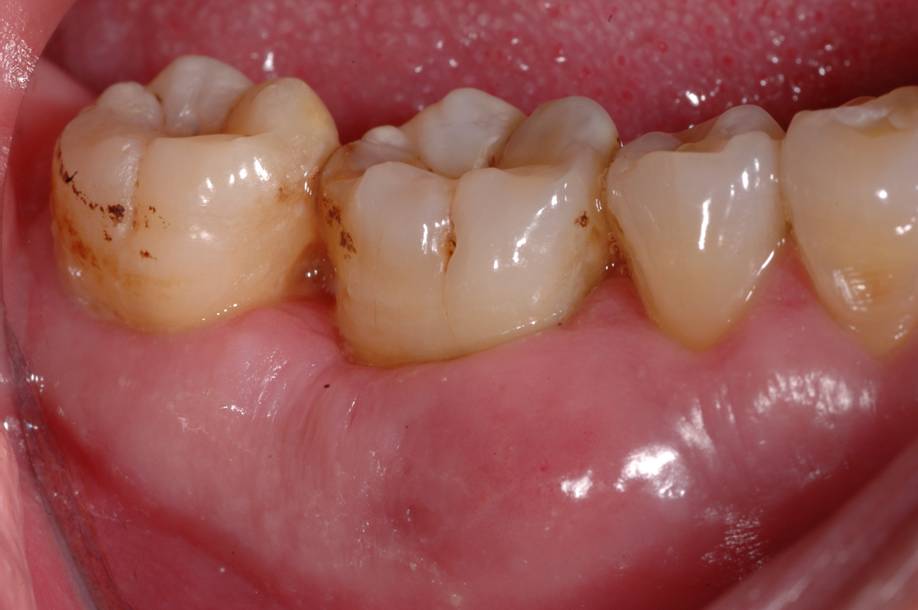 Gums disease in back of mouth can show molar teeth pain