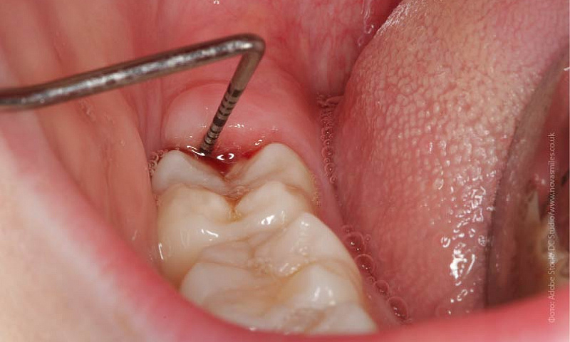 Gums over wisdom tooth get infected due to food trapement and area around wisdom tooth hurt badly when touched