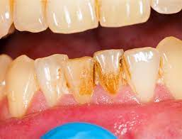 Hard plaque on teeth making teeth yellow