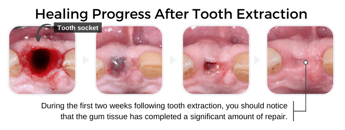 How Long Does It Take for Gums to Heal After Tooth Extraction? A Complete Guide to Healing and Recovery