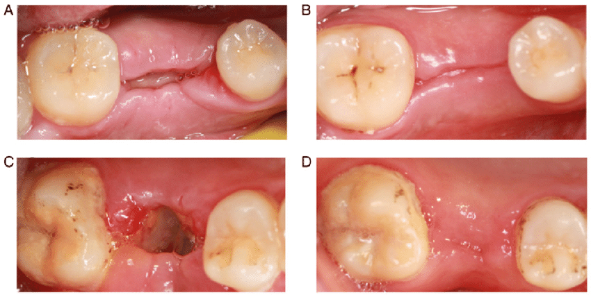 Wound Healing after tooth extraction