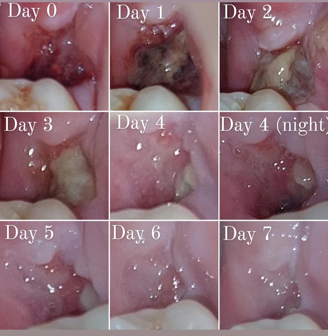 Healing Stages after wisdom teeth removal