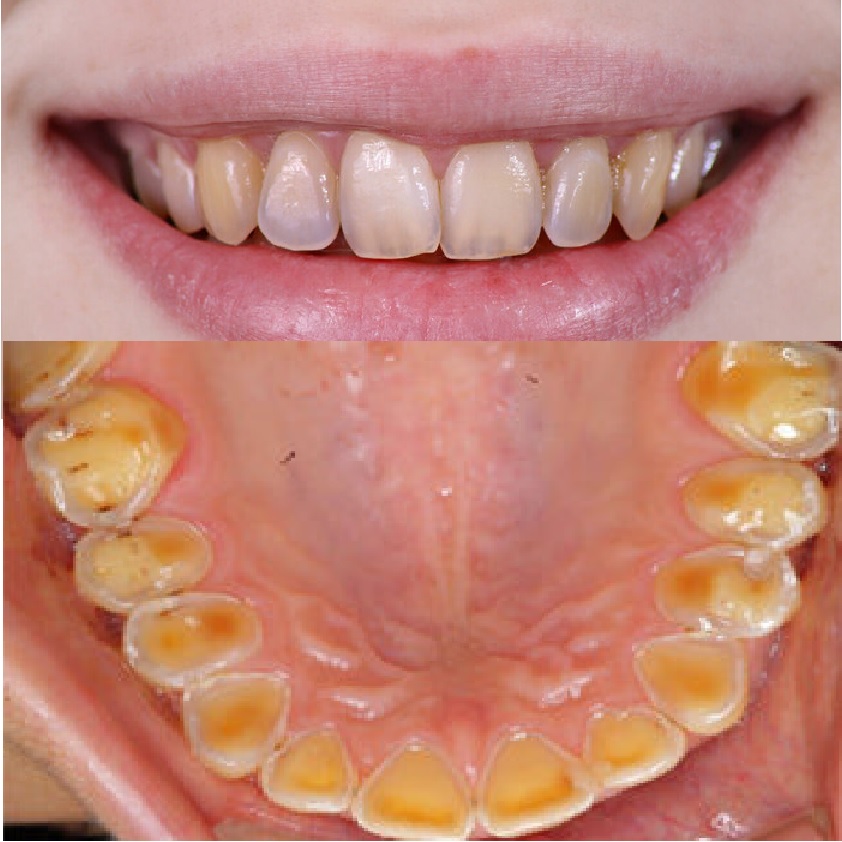 How Acid Erosion Leads to Translucent Teeth and How to Stop It