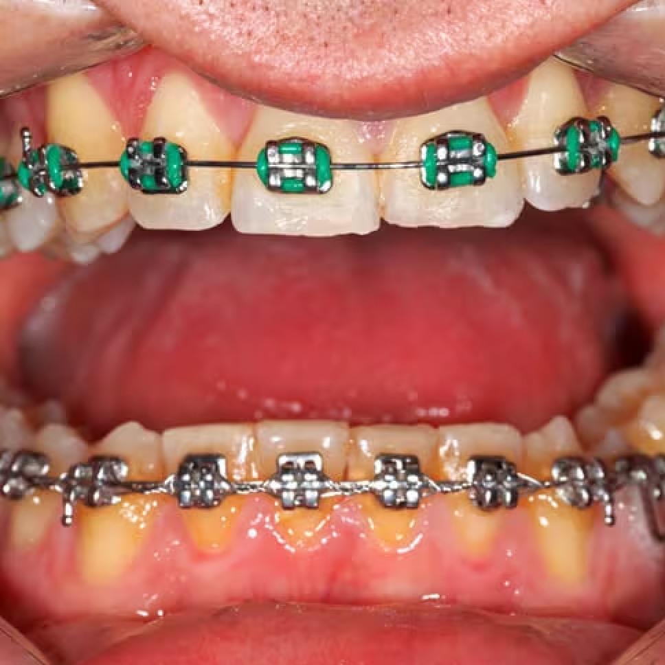 How Braces and Dental Appliances Can Contribute to Tooth Decay