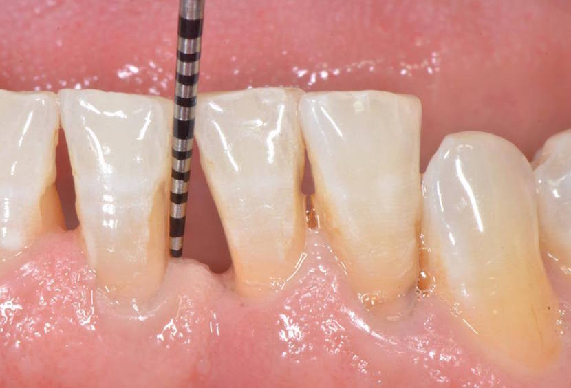 How Long Does a Loose Tooth Take to Fall Out in Adults? measuring the surrounding bone support of tooth