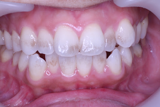 How to Prevent Teeth from Becoming Translucent