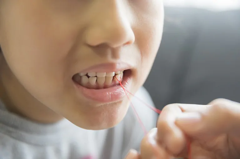 How to Safely Pull a Loose Tooth at Home with Dental Floss