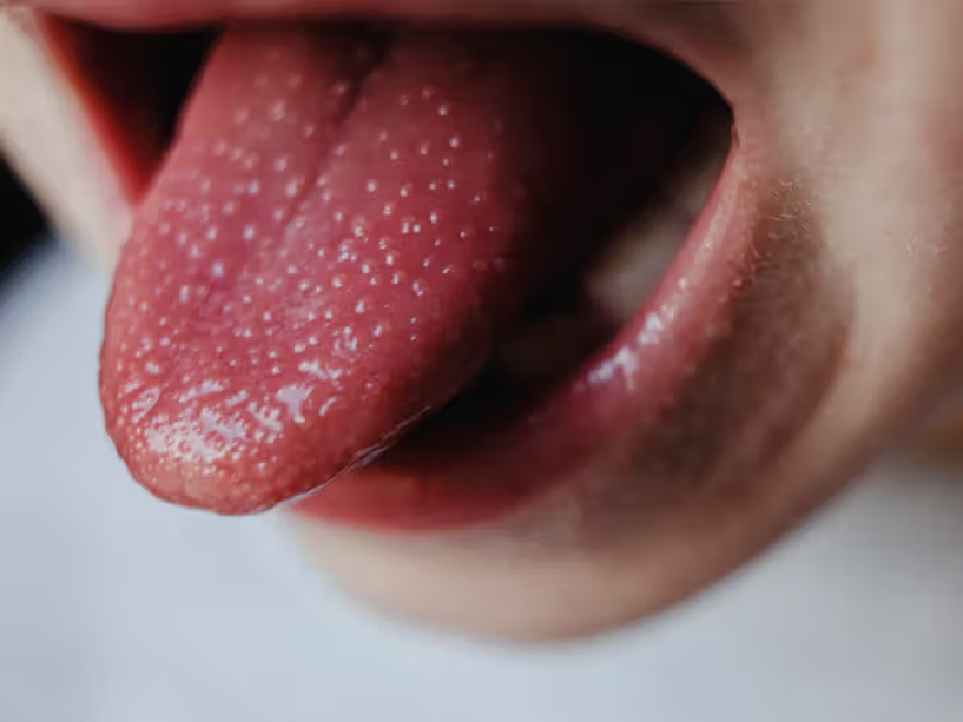 Inflamed Taste Buds: Causes, Symptoms, and Effective Remedies for Swollen Taste Buds