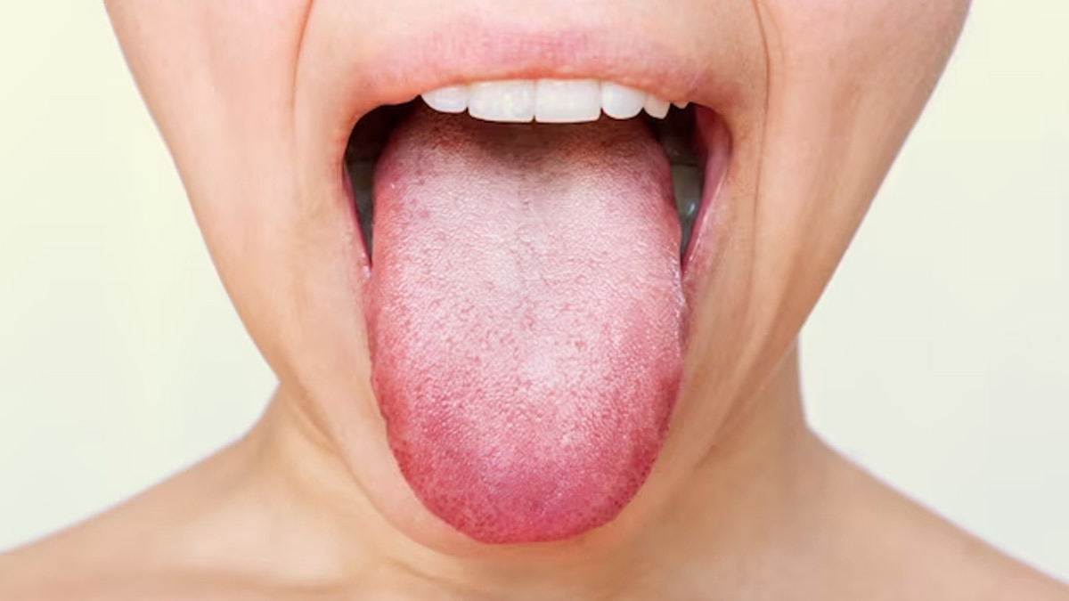 Inflamed Taste Buds: