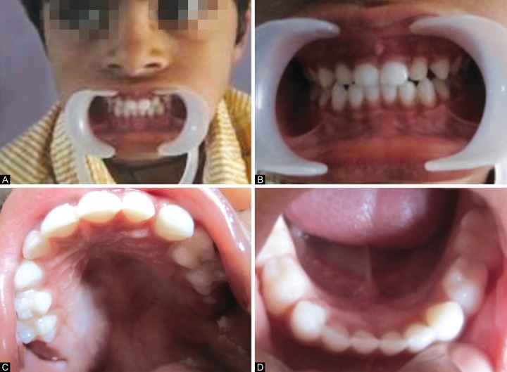 Intraoral photographs of a child-How Many Teeth Do Kids Have