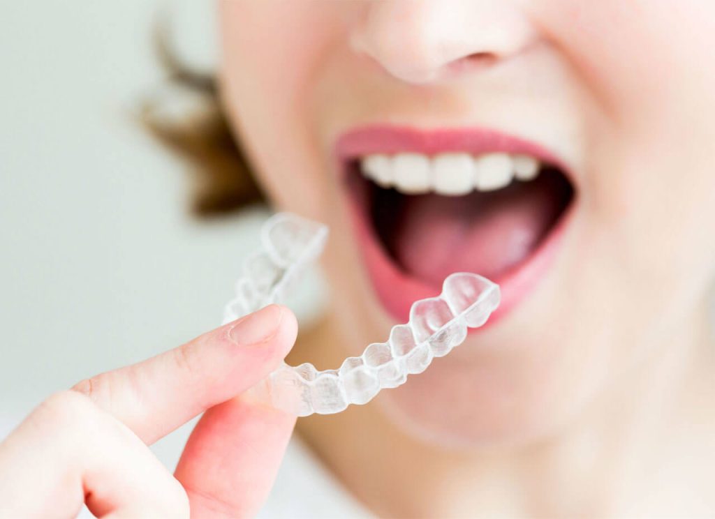 Invisalign-How Do Clear Aligners Work