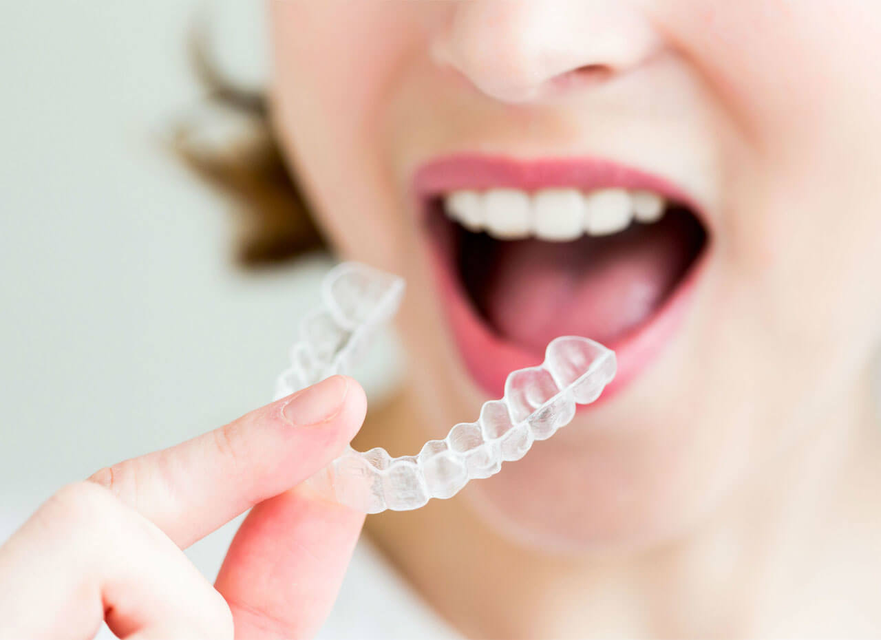 How Do Clear Aligners Work? A Detailed Breakdown of Clear Aligner Therapy