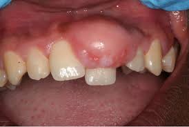 Irritation Fibroma- injury of gums with calculus and plaque cause soft painless lump on gum