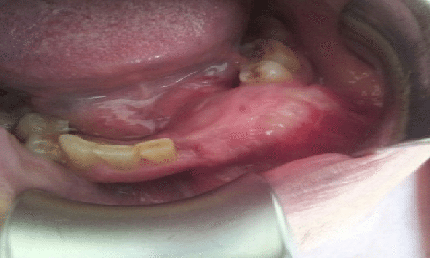 Jaw-cancer-picture-Tumor-in-the-region-of-symphysis-and-parasymphysis-of-the-lower-jaw-on-the-left-side