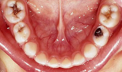 Kids teeth showing molar teeth decay 