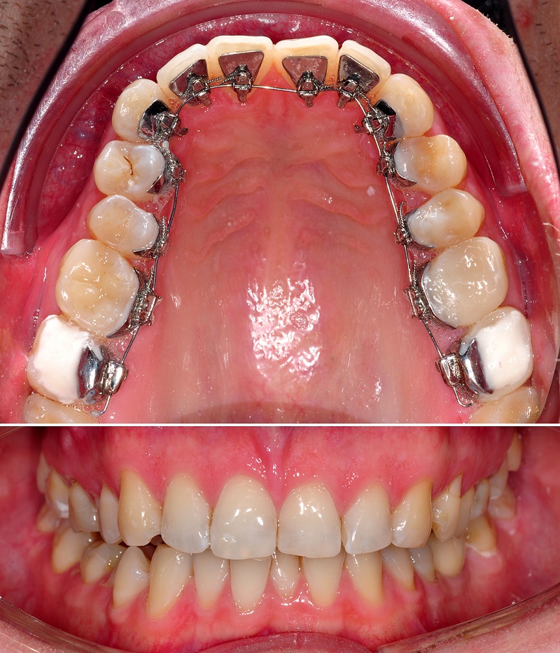 Lingual Braces Option for Adults