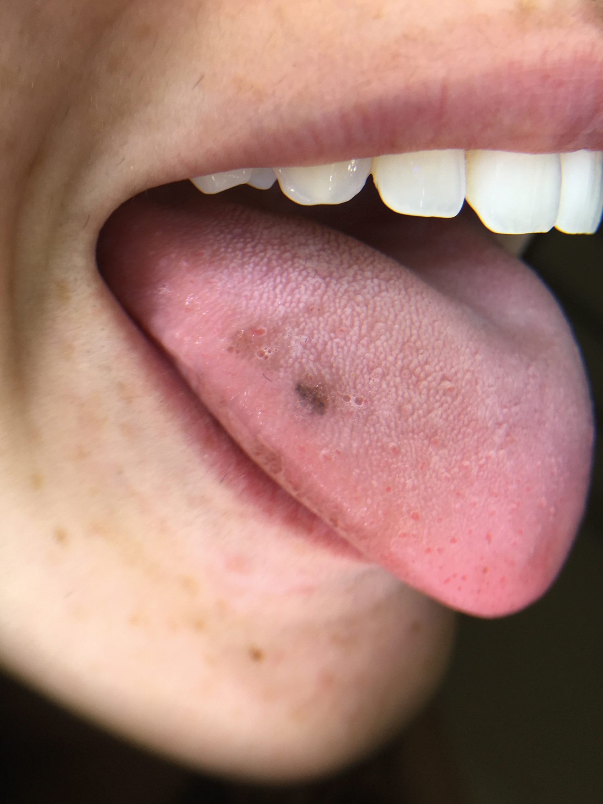 Lingual melanotic macule as black spot on tongue