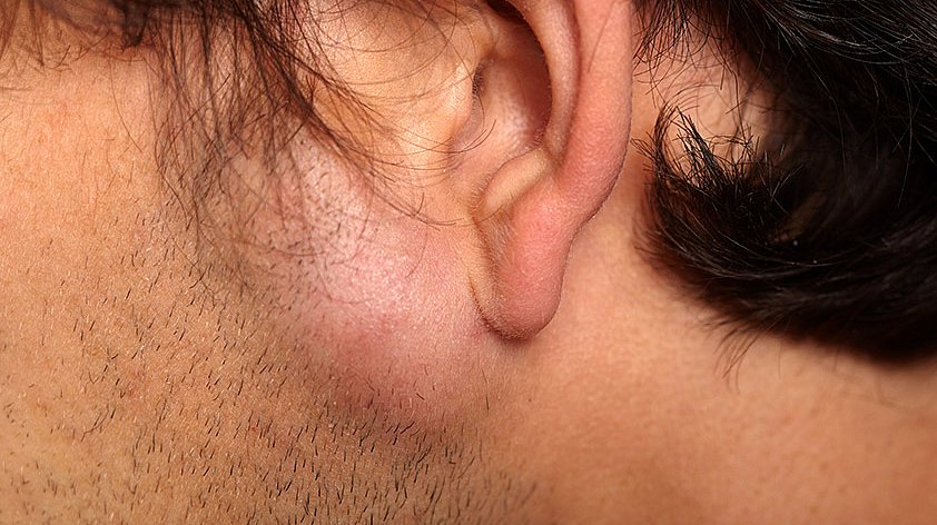 Lipoma lump on jawline