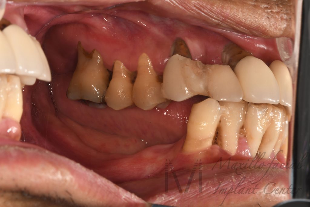 Loose teeth due to sever periodontitis (gum disease)