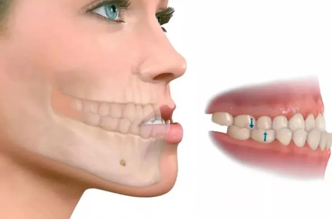 Malocclusion- the wrong arrangement of upper teeth to lower teeth can result in Jaw clicking or popping jaw