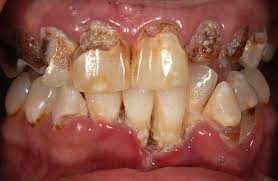 Medications That Can Lead to Rotten Teeth