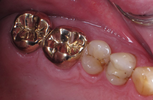 Metal caps on adult teeth