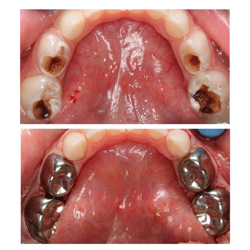 Metal crowns Silver caps on Kids Molars teeth